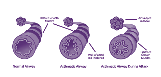 Airway Inflammation Infographic - Advancements in FeNO Testing
